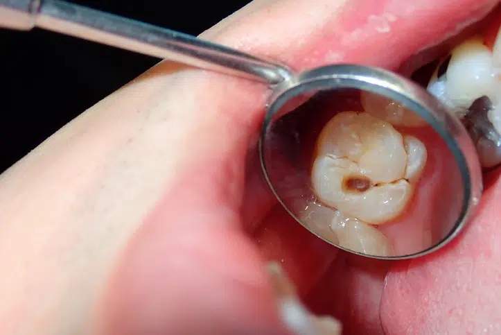 Rotten Teeth? Try These Five Ways To Fix Them!